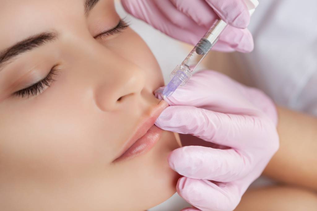 Injection d'acide hyaluronique dans les lèvres