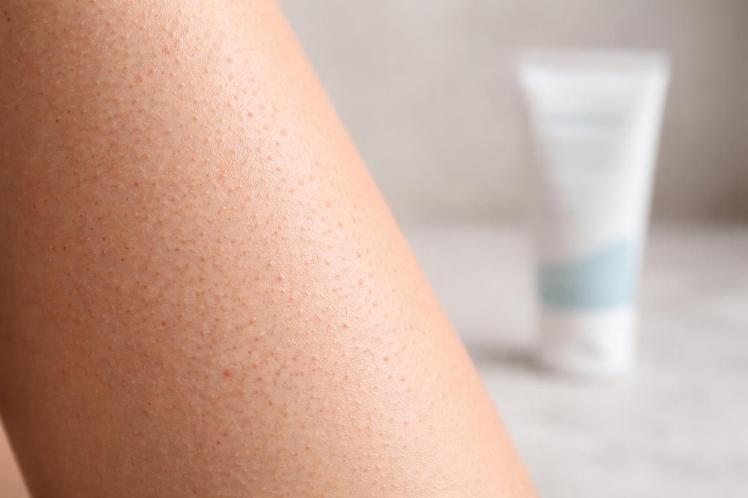 découvrez la vérité sur la kératose pilaire et les mythes entourant les traitements miracles. apprenez des conseils réalistes pour mieux gérer cette condition de la peau.